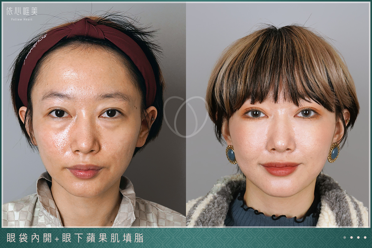 眼袋案例集