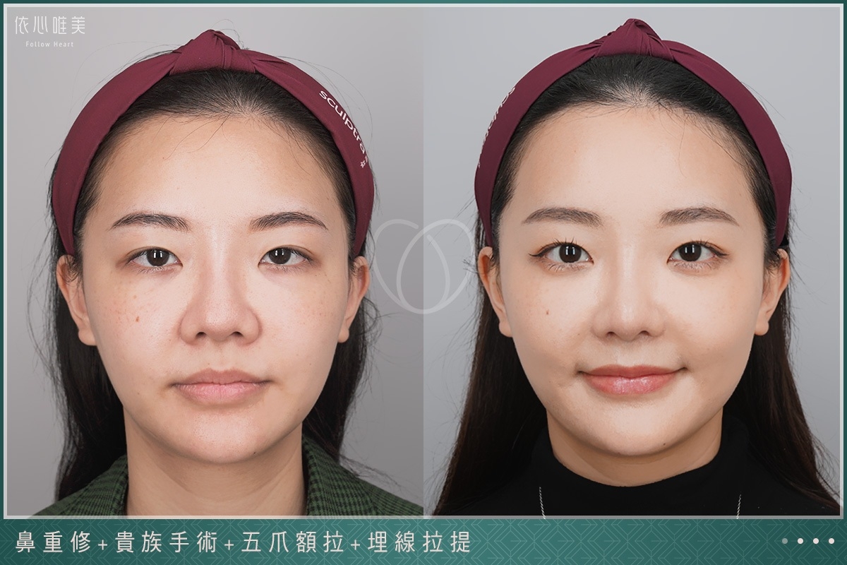 前額拉提案例集