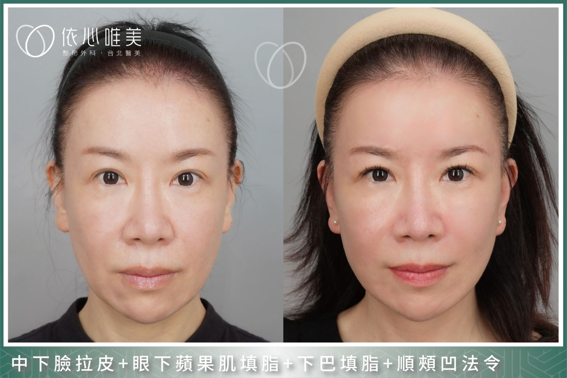 中下臉拉皮案例集