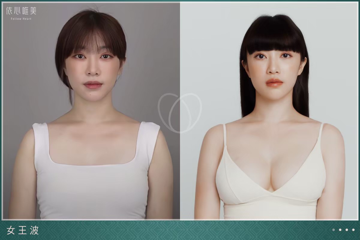 女王波案例集