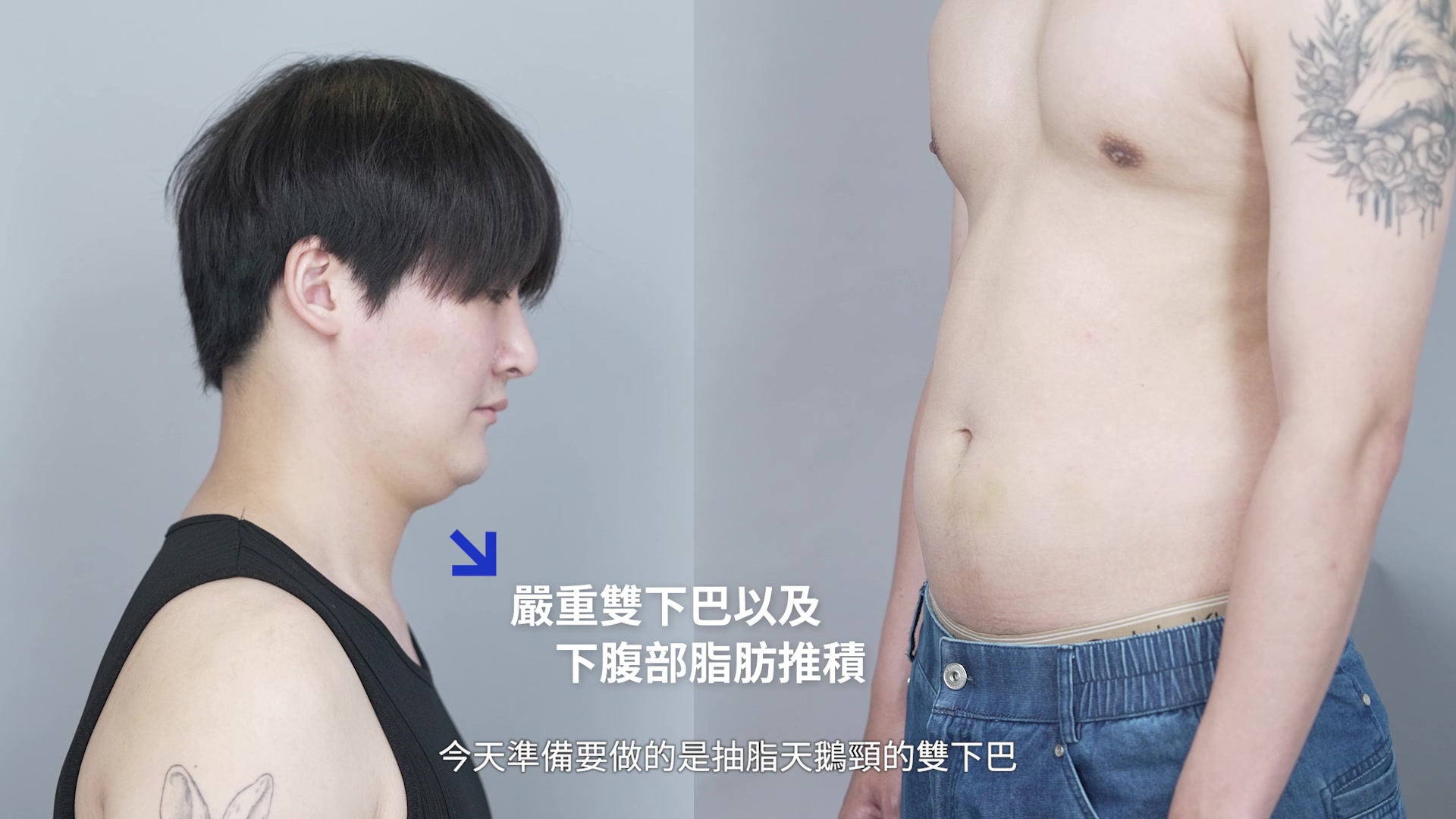 雙下巴與腹部脂肪堆積的困擾，不是靠運動、飲控就能改善
