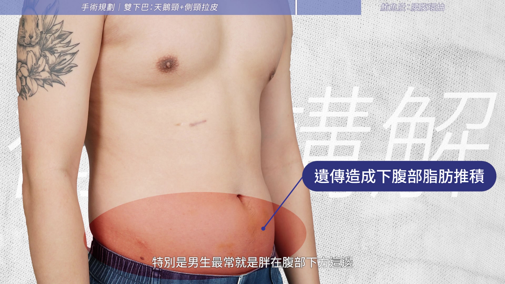 男生下腹部鮪魚肚：威塑腹部環抽的處理方式