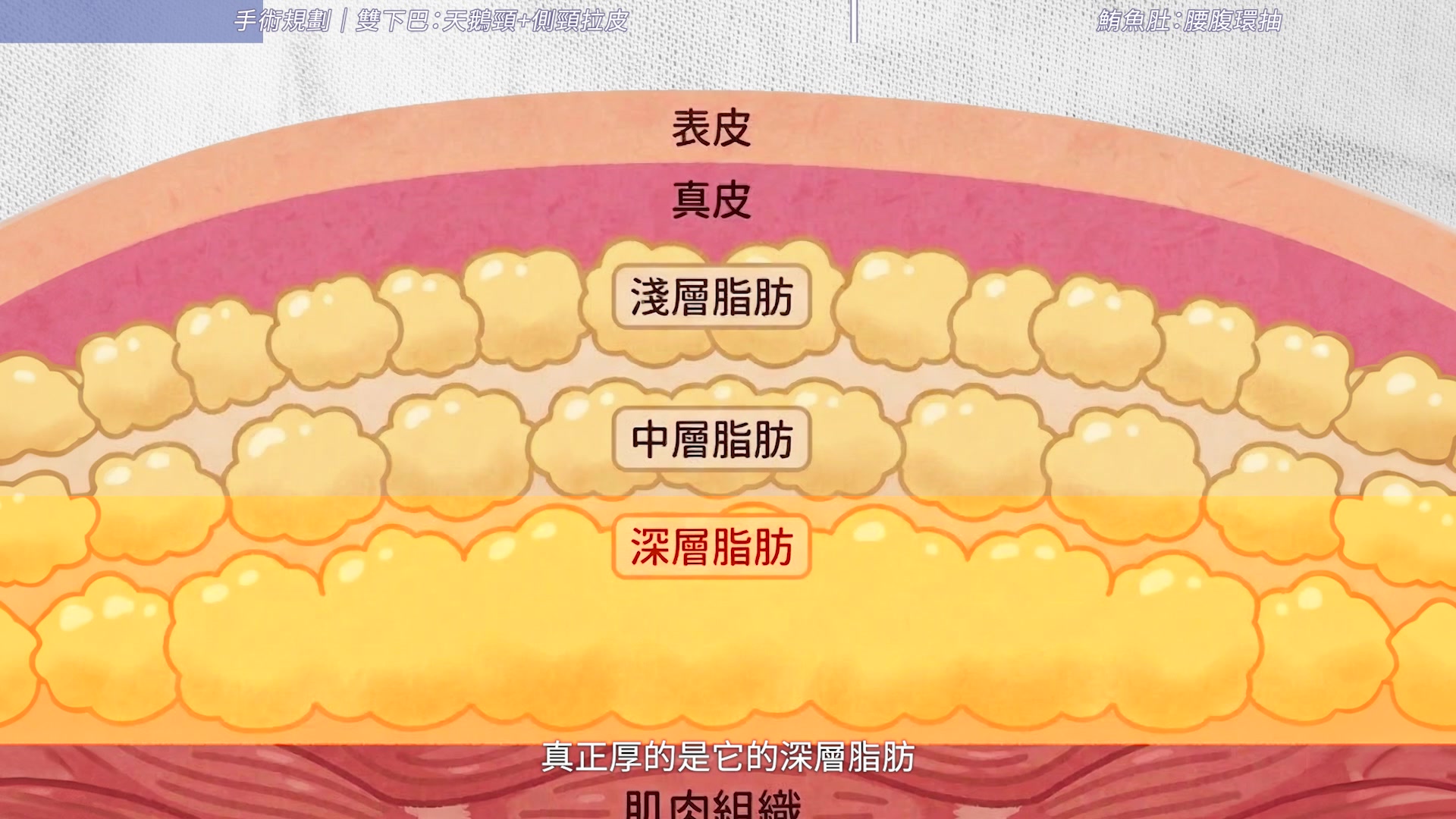 雙下巴脂肪分下巴脂肪分為淺層與深層，深層脂肪墊需要靠天鵝頸手術處理