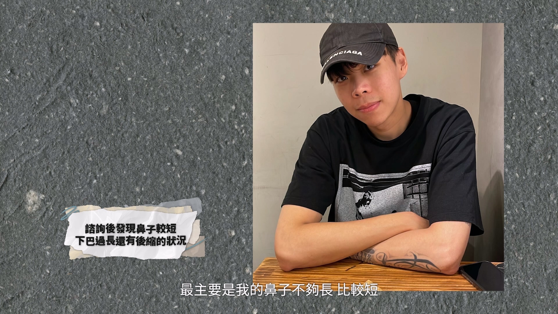 原本想做縮唇,但諮詢後發現是鼻子短,跟下巴長但後縮,導致嘴相對較凸