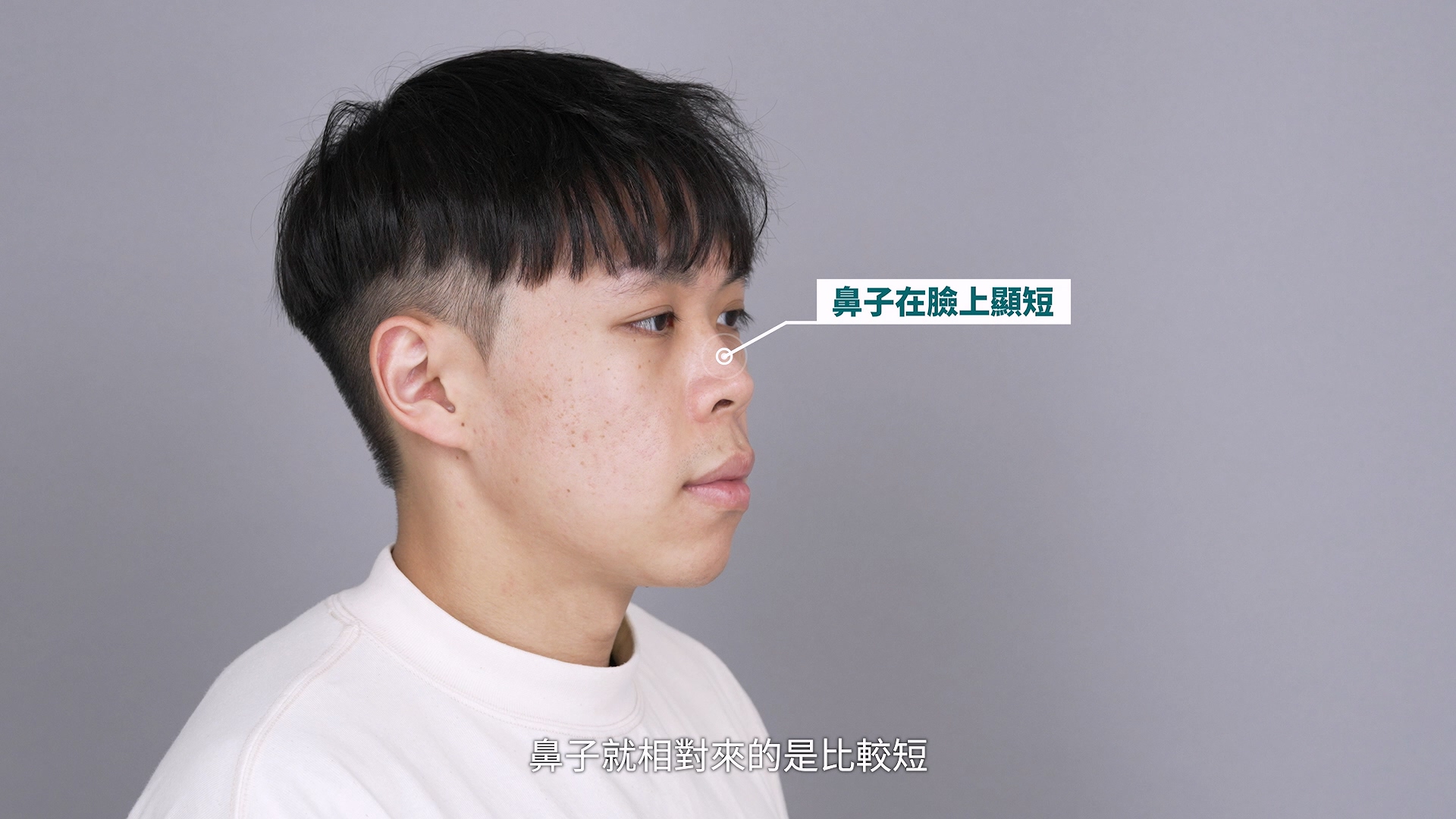 鼻子偏短,正面看起來有些朝天,露鼻孔也比較明顯,可用結構式隆鼻改善