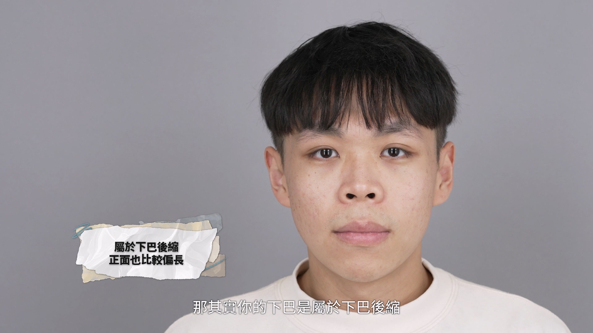 針對我的下巴條件,醫師建議以截骨方式調整,重點是合理增加向前的支撐,而不是讓下巴繼續往下變長
