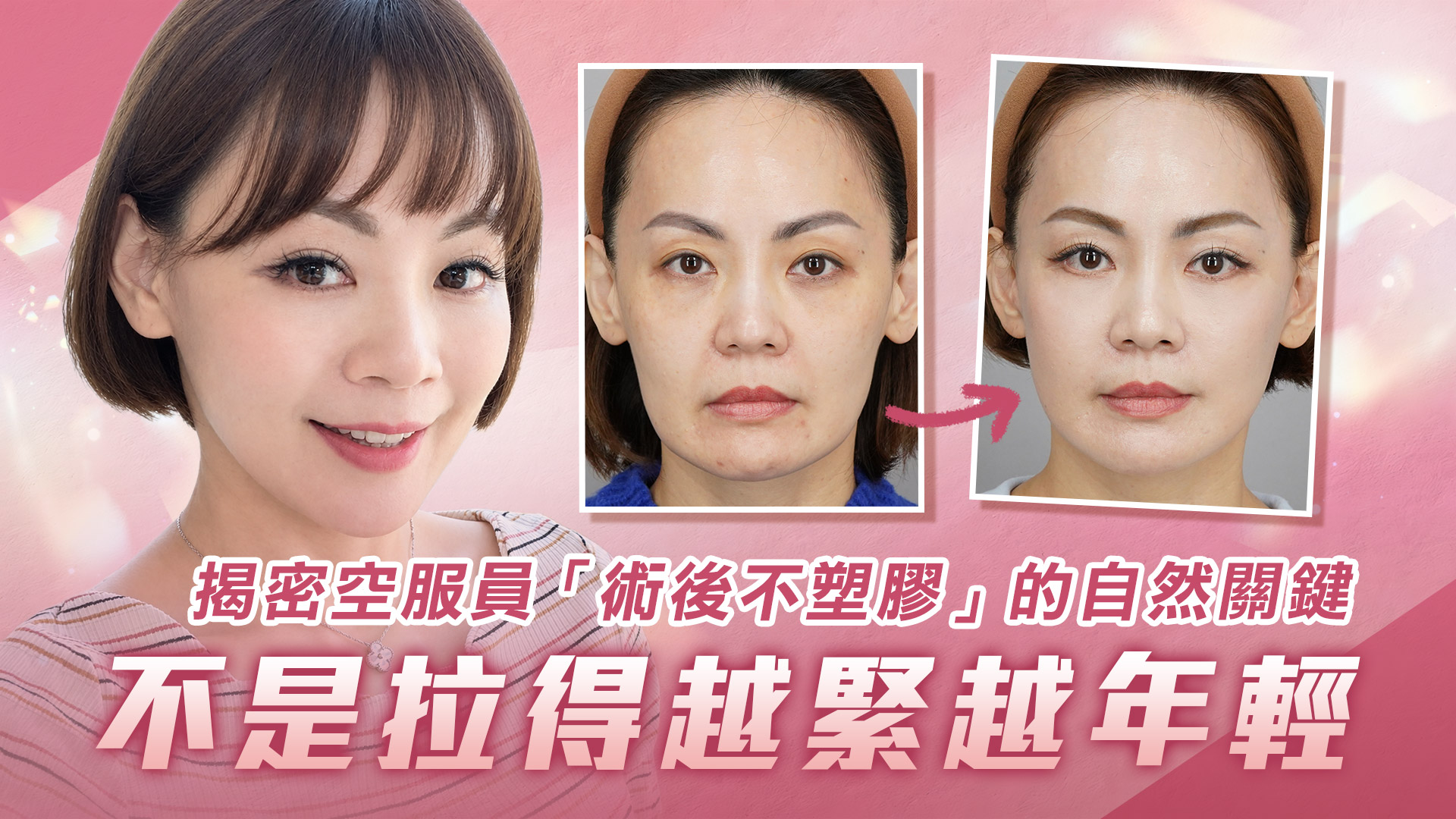 中下臉拉皮真實案例，法令紋、木偶紋、臉部鬆弛改善術後半年分享