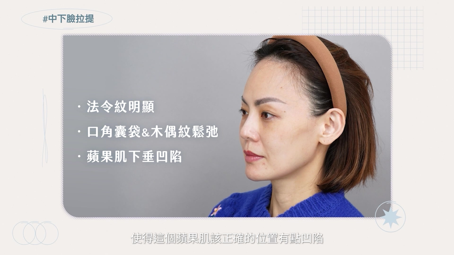 術前問題：法令紋明顯、口角囊袋&木偶紋鬆弛、蘋果肌下垂凹陷