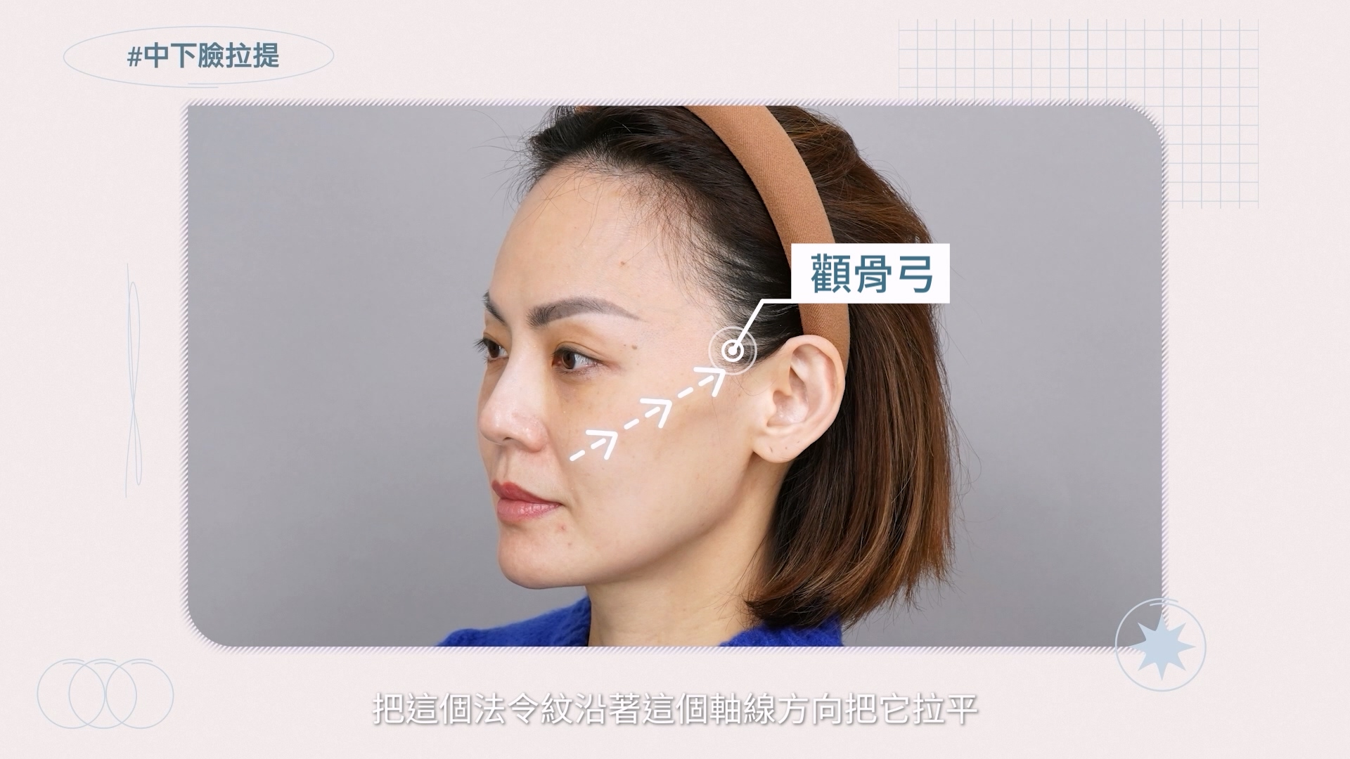 將法令紋和蘋果肌周遭的SMAS深筋膜層固定於顴骨弓附近，改善法令和中臉組織下垂
