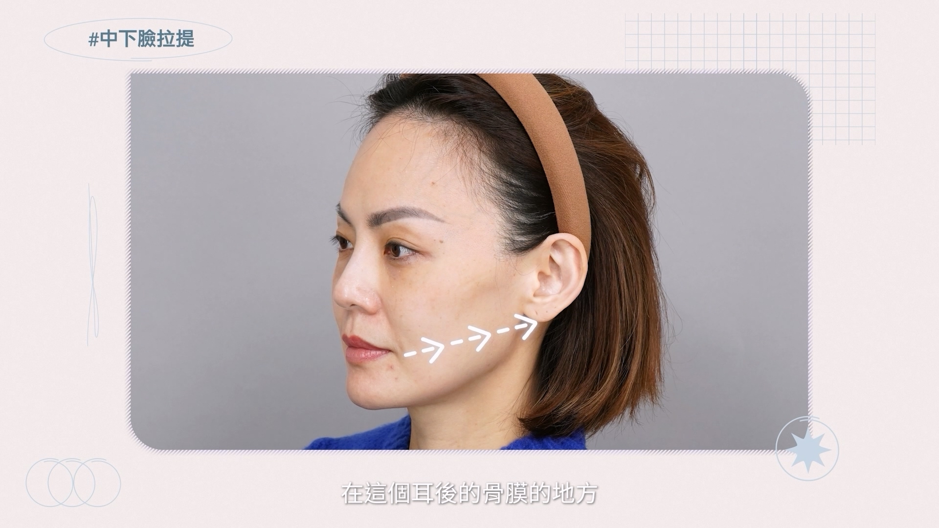 將木偶紋和口角囊袋周遭的SMAS深筋膜層固定於耳後骨膜附近，改善下臉鬆弛和下顎輪廓