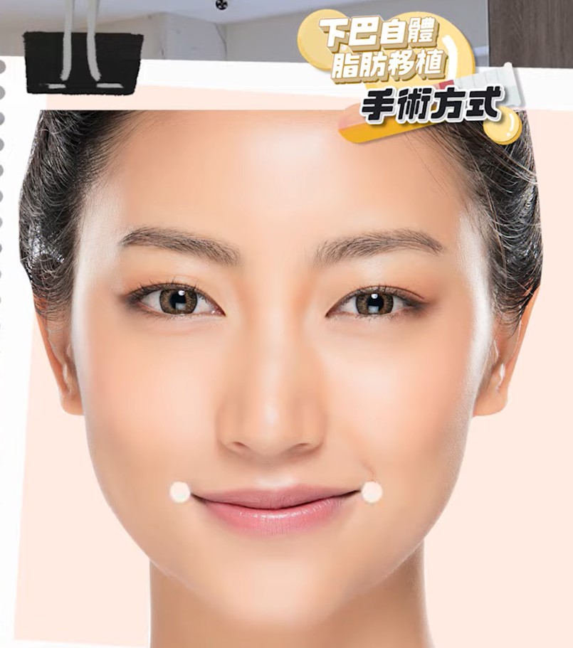 下巴自體脂肪移植介紹！適合哪些人？恢復期？維持多久？