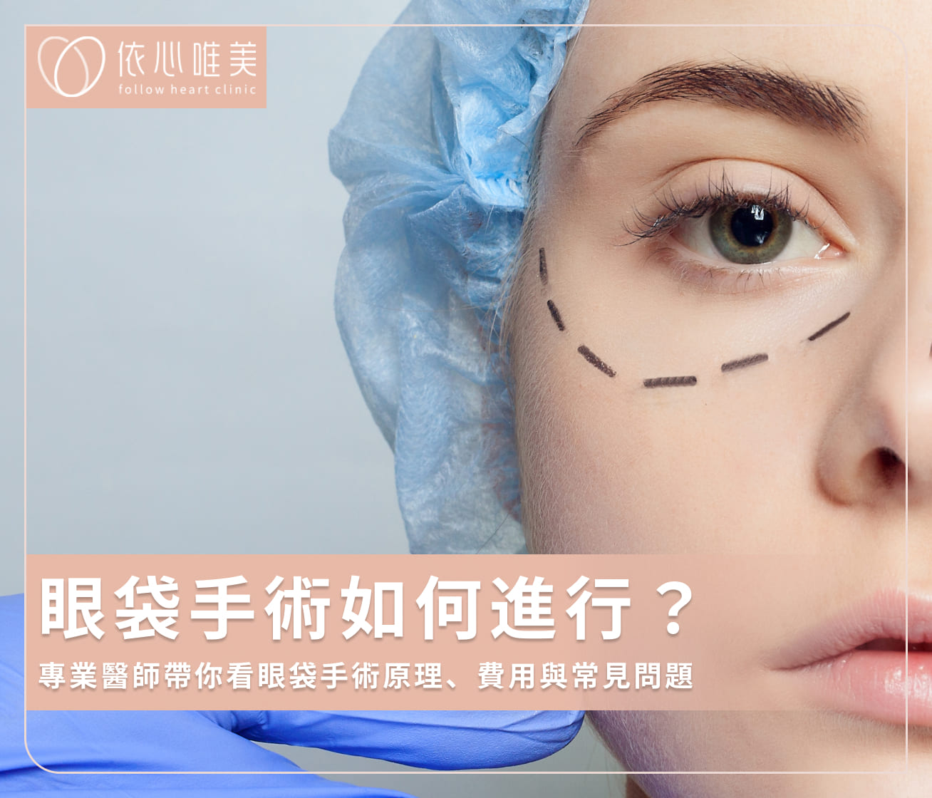 眼袋手術能維持多久？內開／外開眼袋手術費用、術後注意事項一覽