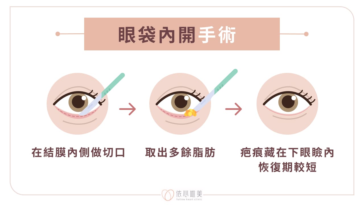 眼袋內開手術
