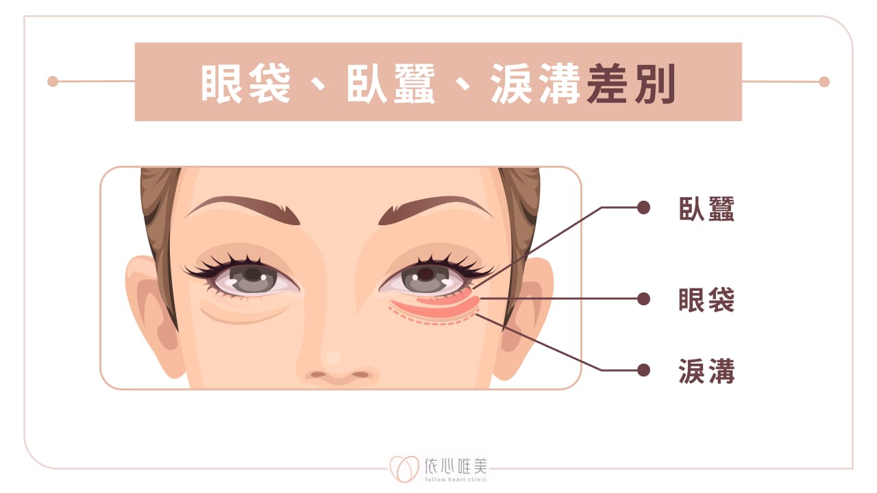 眼袋、臥蠶、淚溝差別