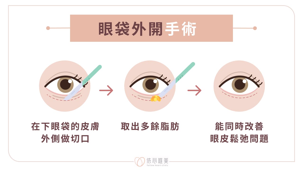眼袋外開手術