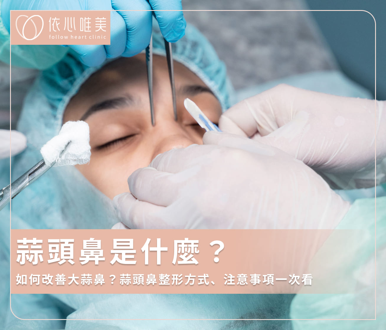 蒜頭鼻是什麼？如何改善大蒜鼻？蒜頭鼻整形方式、注意事項一次看