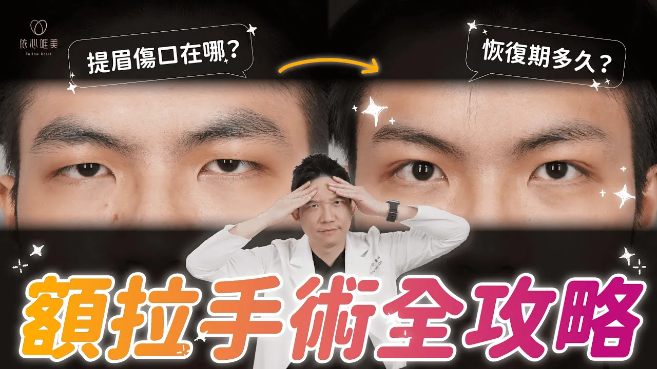 五爪額拉是什麼？內視鏡額拉提眉手術拯救下垂眉壓眼