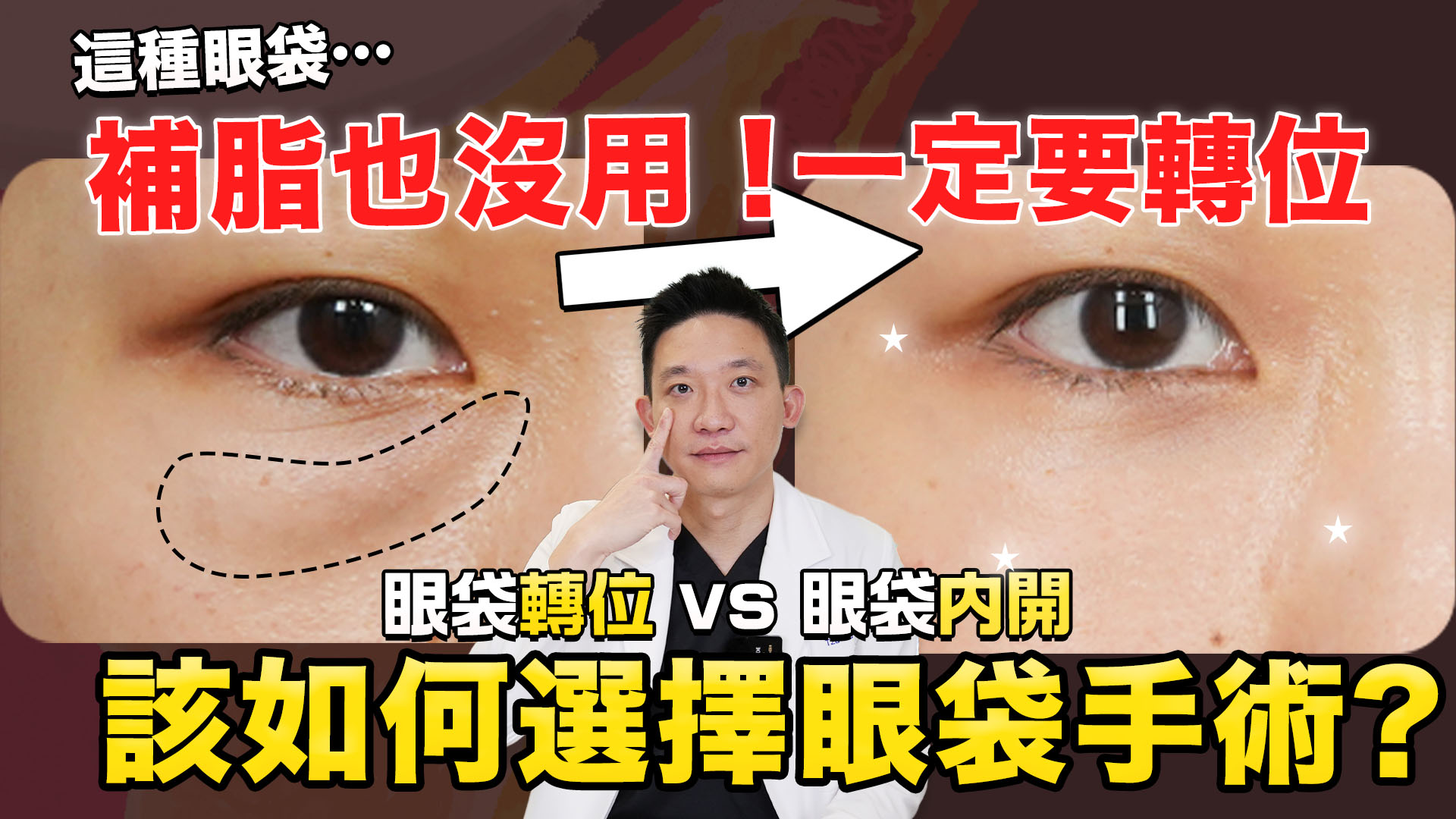 2024更新︎︎✨一次了解眼袋轉位！適合誰？跟內開不同？能合併補脂？