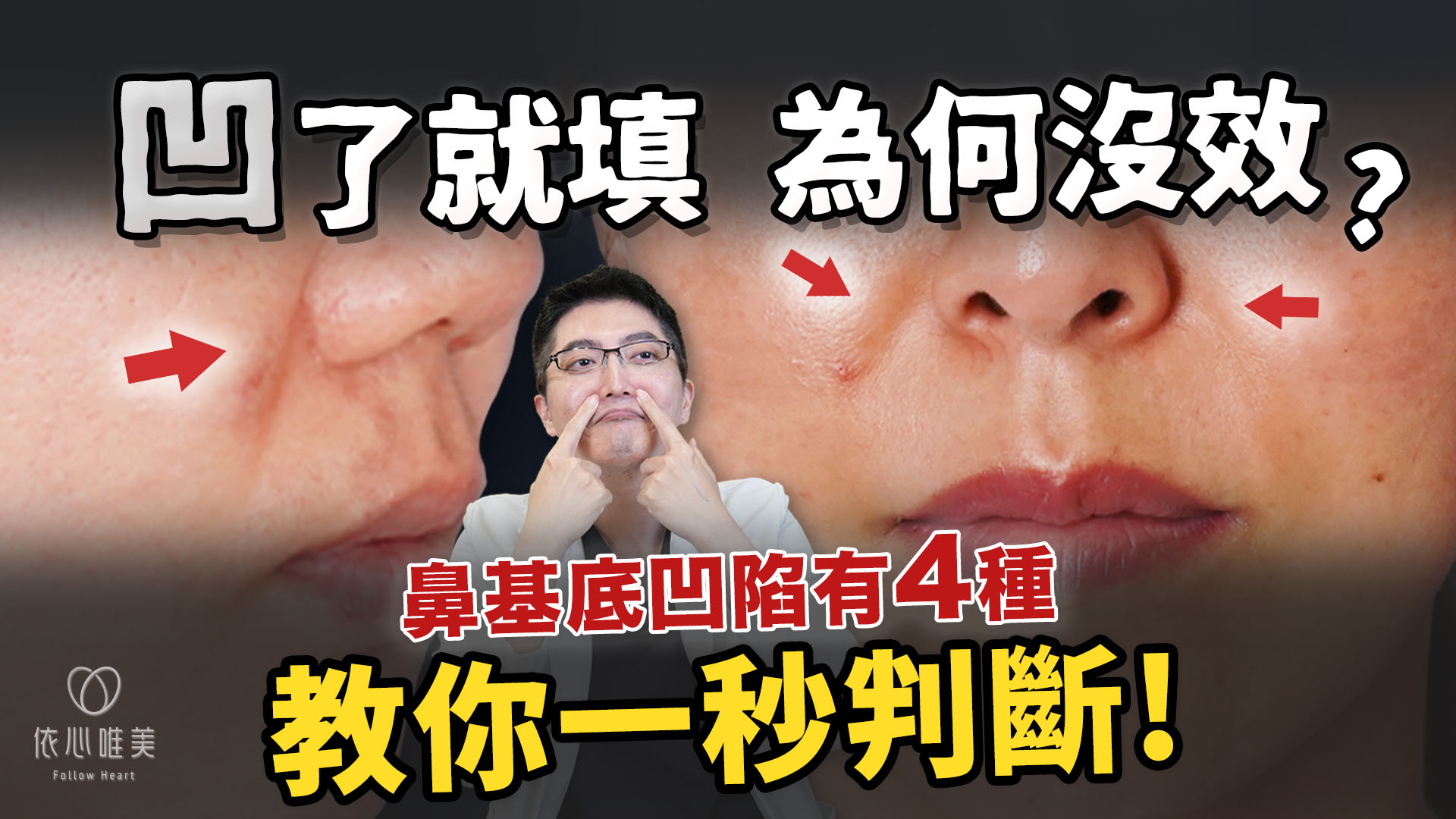 鼻基底凹？不是每個人都適合貴族手術！