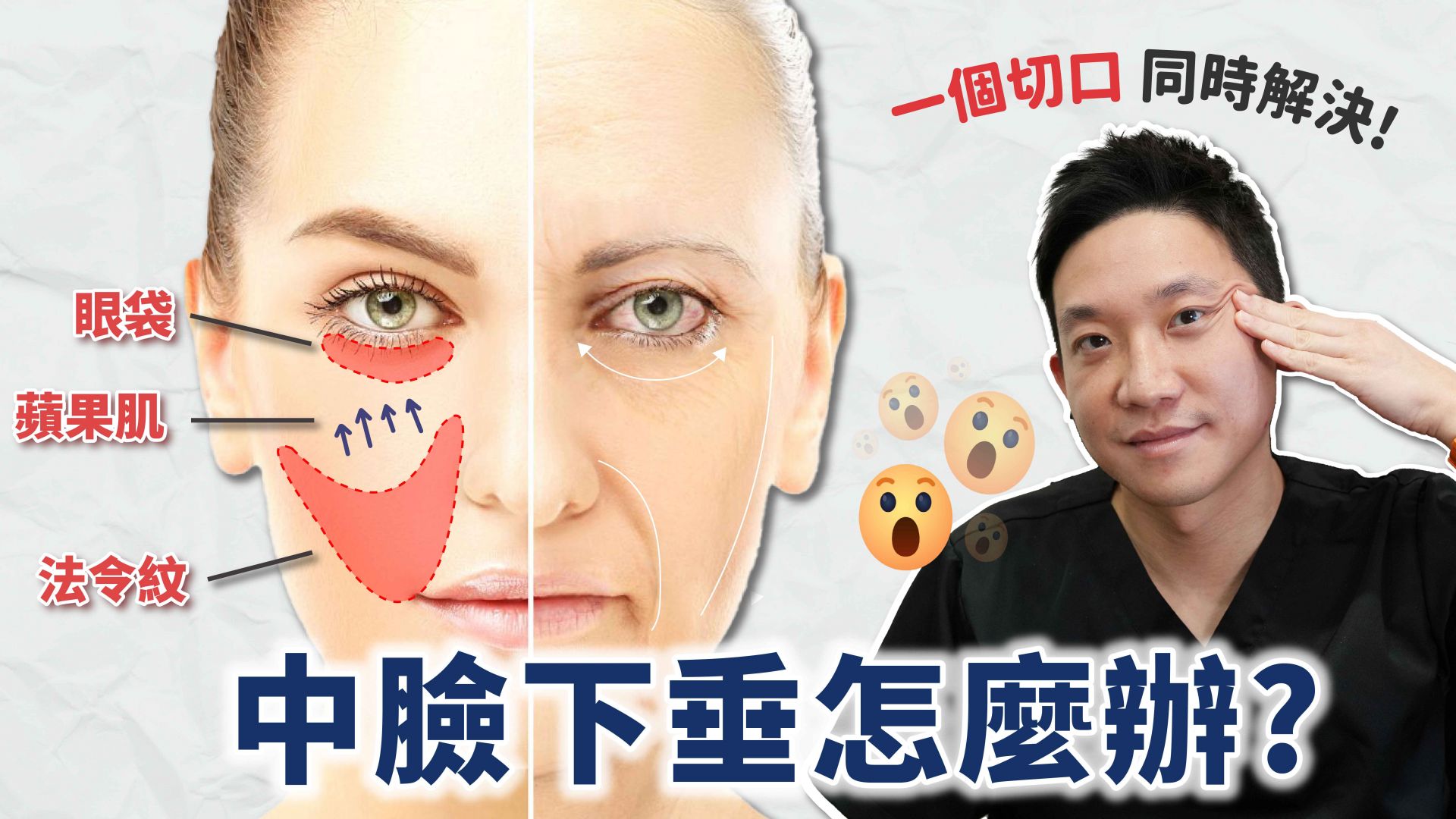 中臉拉皮是什麼？一次解決眼袋、法令紋、蘋果肌下垂？
