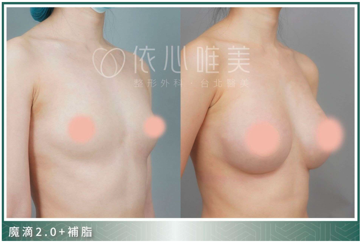 依心唯美隆乳案例