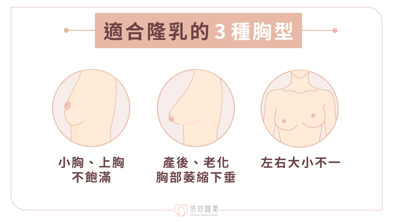 適合隆乳的 3 種胸型