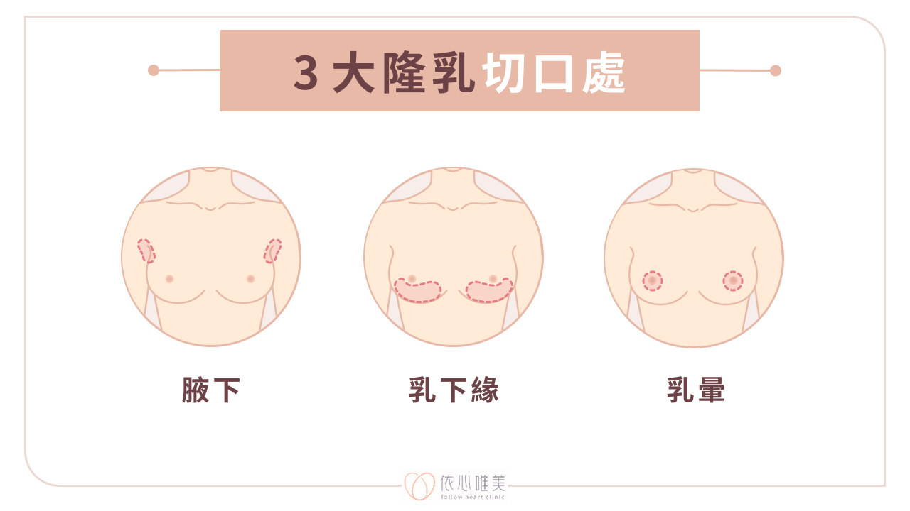 3 大隆乳切口處