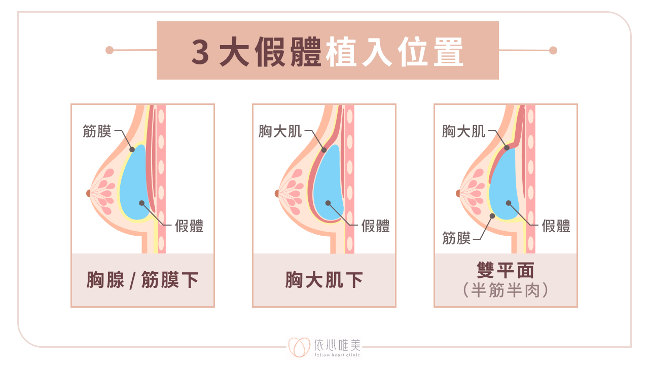 3 大假體植入位置