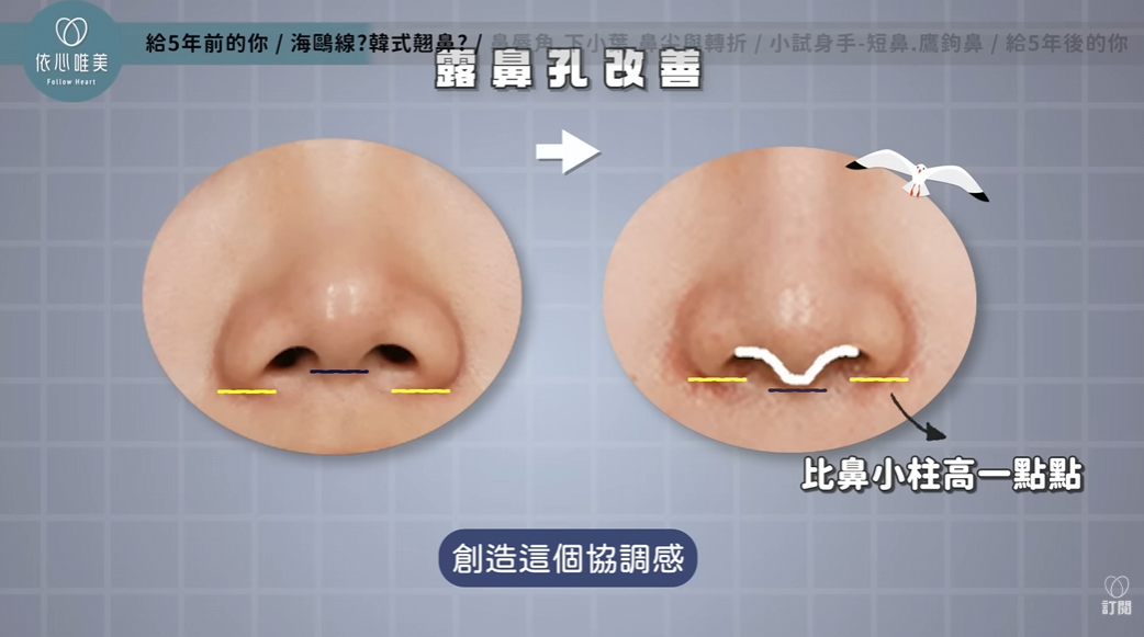 隆鼻手術改善露鼻孔問題與海鷗線比例示意圖