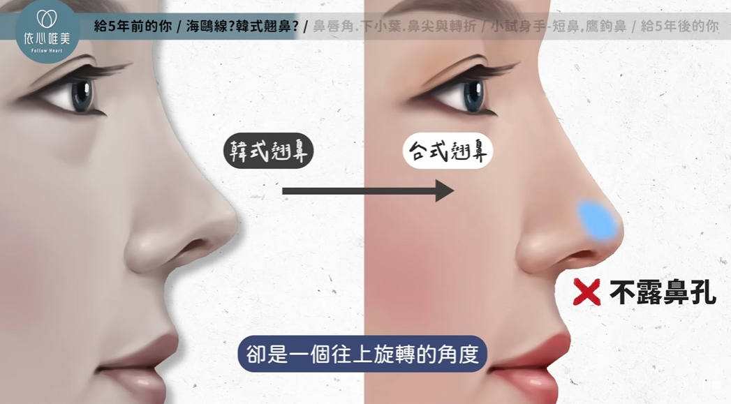 韓式翹鼻與台式自然感小翹鼻差異示意圖
