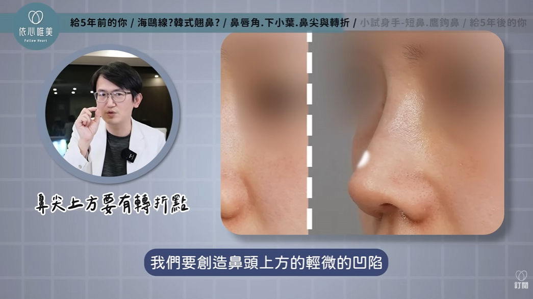 自然感隆鼻中鼻尖上方轉折點與輕微凹陷示意圖