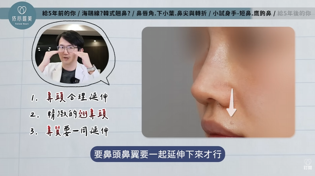自然感小翹鼻中鼻頭與鼻翼同步延伸示意圖