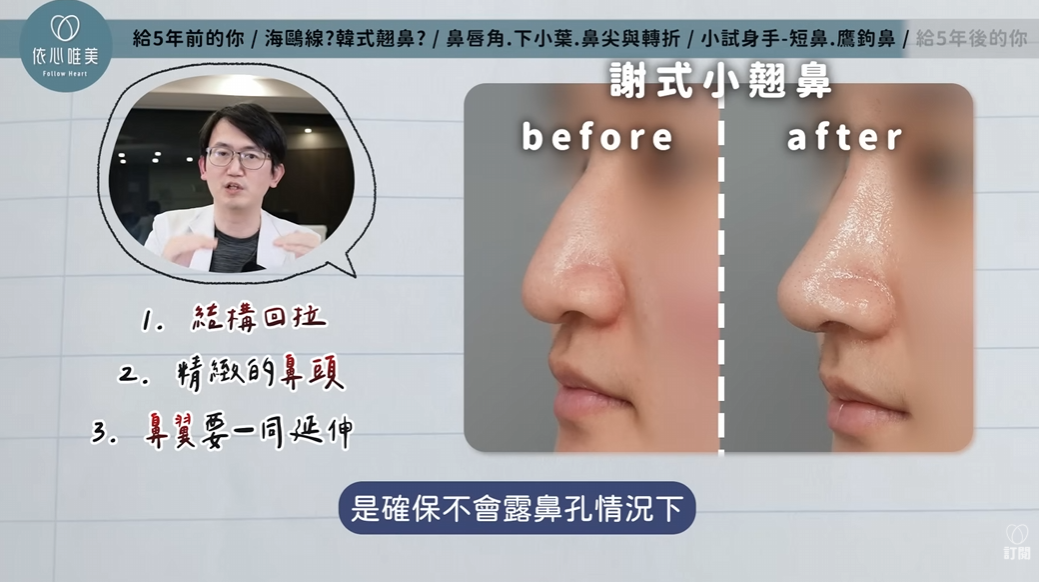鷹鉤鼻改善與自然感小翹鼻結構回拉術前術後示意圖