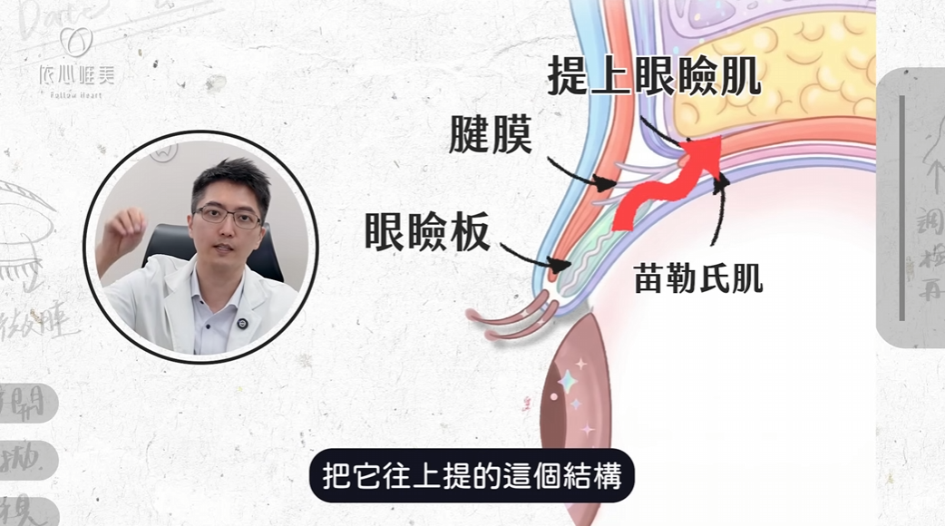眼瞼筋膜與提上眼瞼肌結構示意圖
