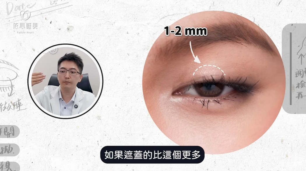 輕度提眼肌無力造成的上眼皮遮蓋情況