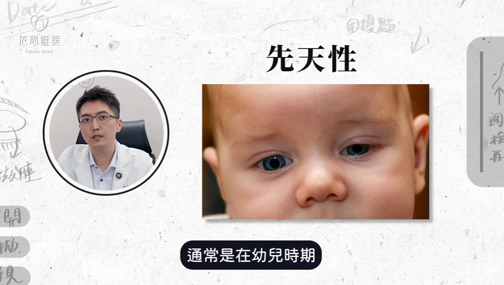 先天性提眼瞼肌無力