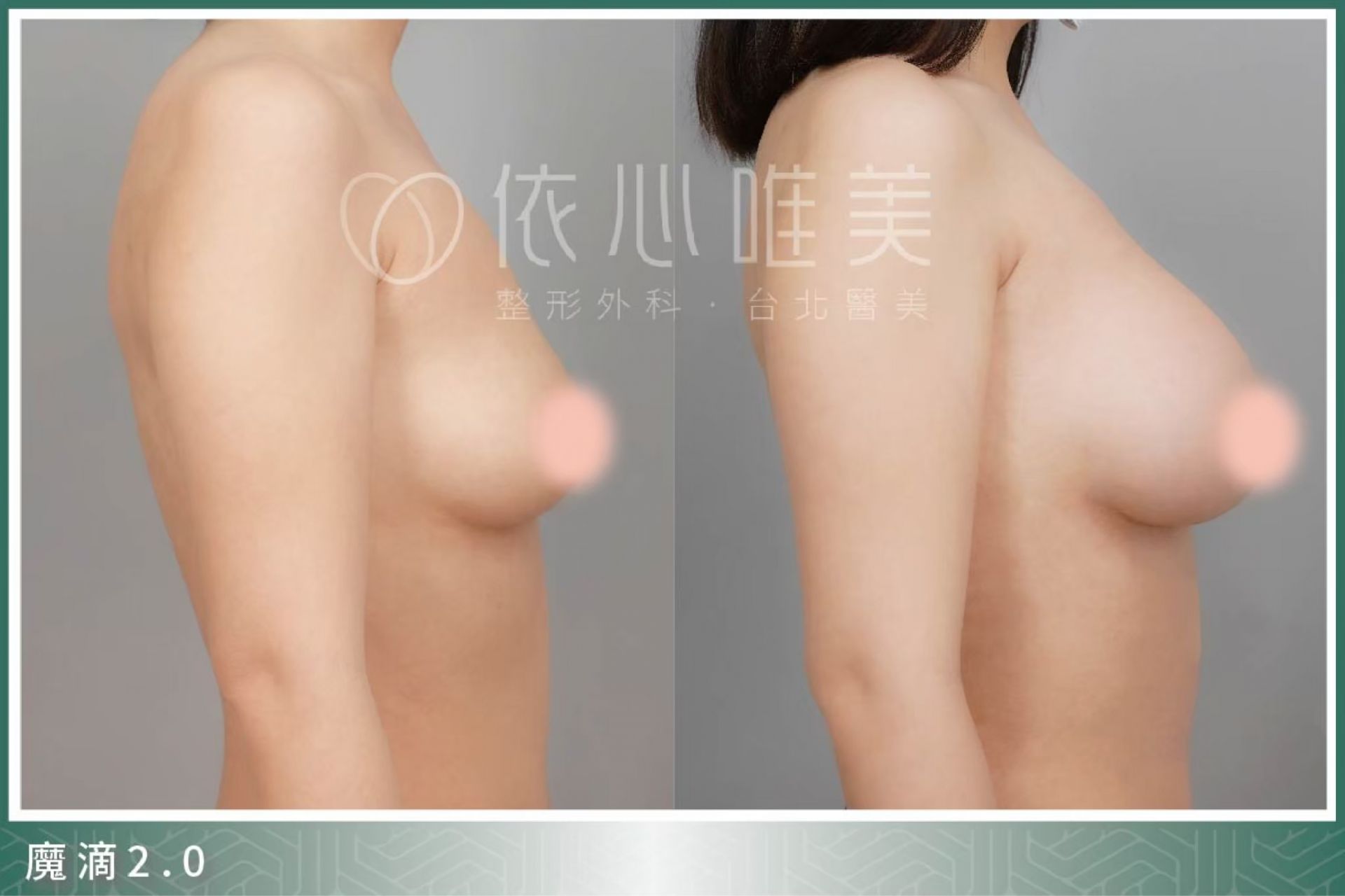 魔滴 2.0 Motiva JOY 隆乳案例3