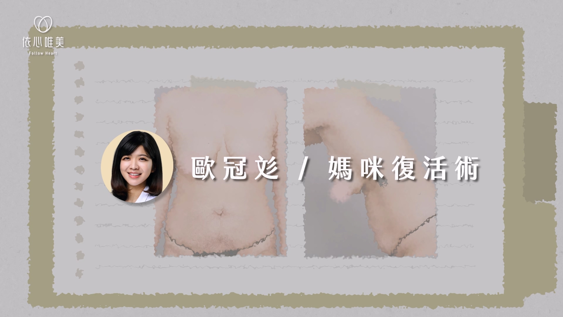 影片案例中，歐冠彣醫師依不同問題搭配腹部拉皮、腰腹抽脂及隆乳等手術規劃