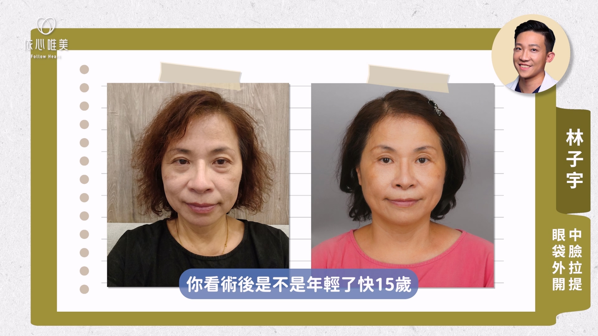 影片中，林子宇醫師針對案例規劃眼袋手術合併中臉拉提。