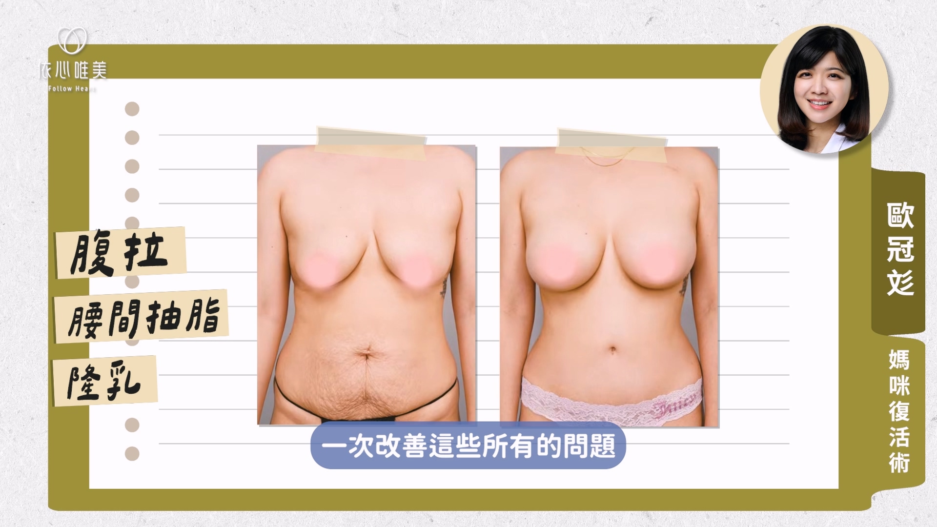 生產、哺乳之後,很多媽媽會遇到肚皮鬆弛皺褶、腰身消失、胸型萎縮下垂等問題。「媽咪復活術」就是針對這些困擾,一次處理腹部贅皮、腰間脂肪、胸型下垂等問題,由歐冠彣醫師整合腹部拉皮、抽脂、隆乳三項手術同步進行。