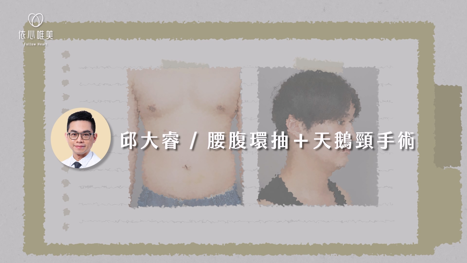 即使認真健身、體脂持續下降，有些部位（例如腹部、雙下巴）還是「怎麼練都練不掉」，這時候就可以考慮手術輔助雕塑