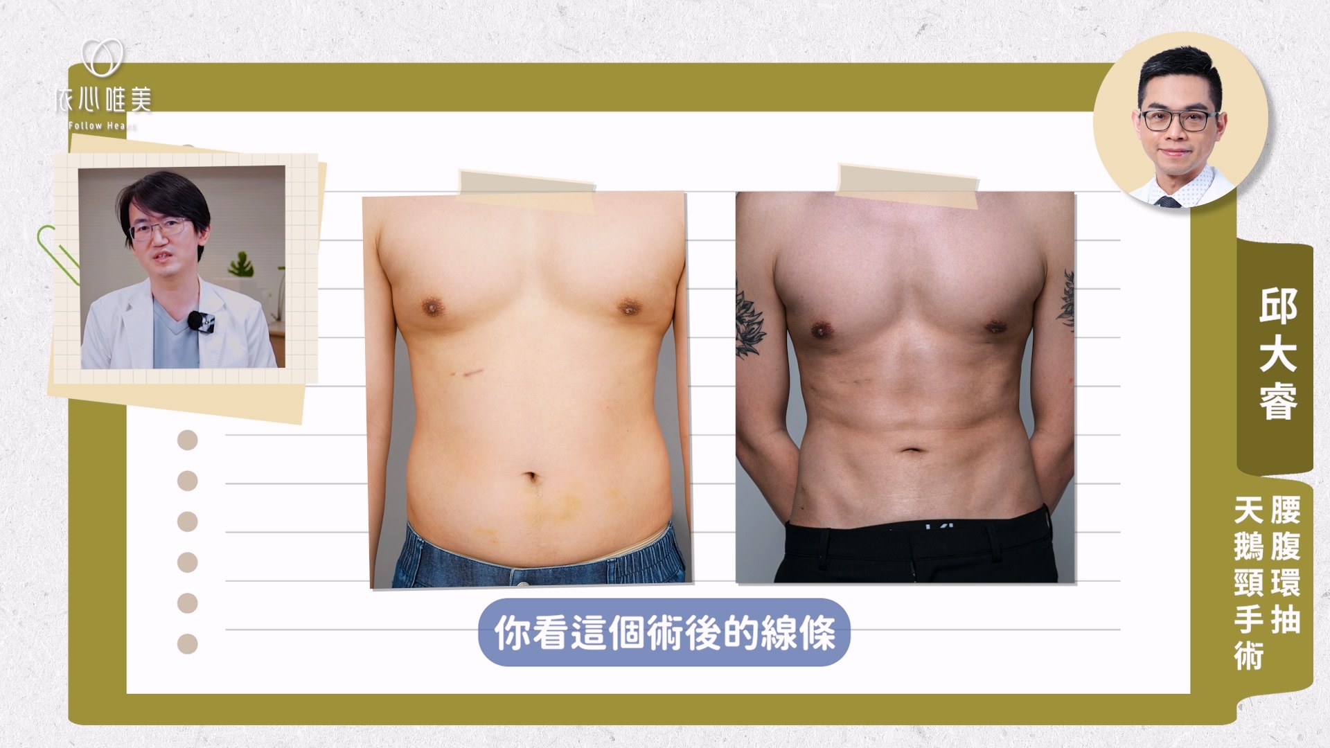 邱大睿醫師針對腹部進行抽脂,再進一步雕塑出六塊肌線條,讓術後線條更立體吸睛