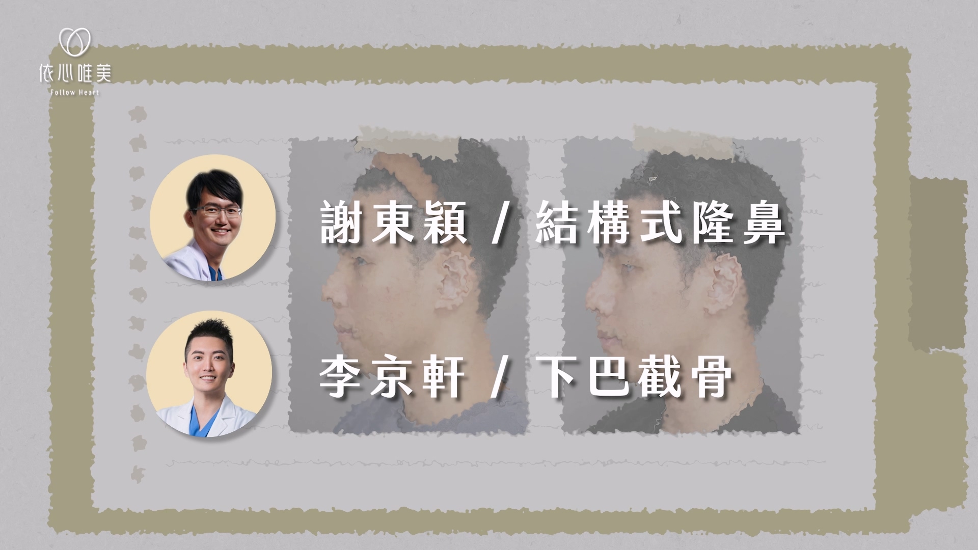 第五個案例是我與李京軒醫師合作的案例：男性個案臉部比例不錯，但鼻子偏短、下巴後縮