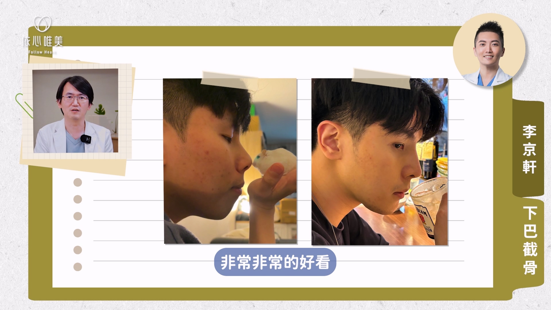 下巴骨頭往前移動改善後縮的同時,也要把下巴的長度做短一點,才能兼顧側面線條與正面比例的協調