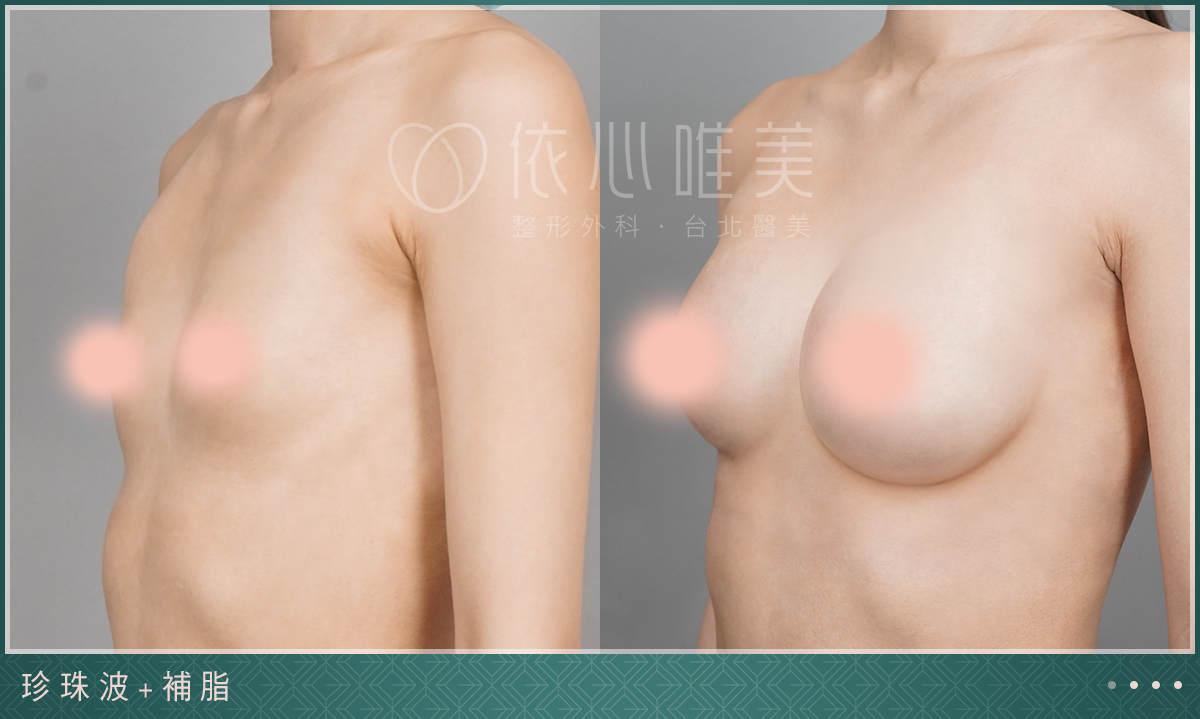 珍珠波＋自體補脂隆乳案例2