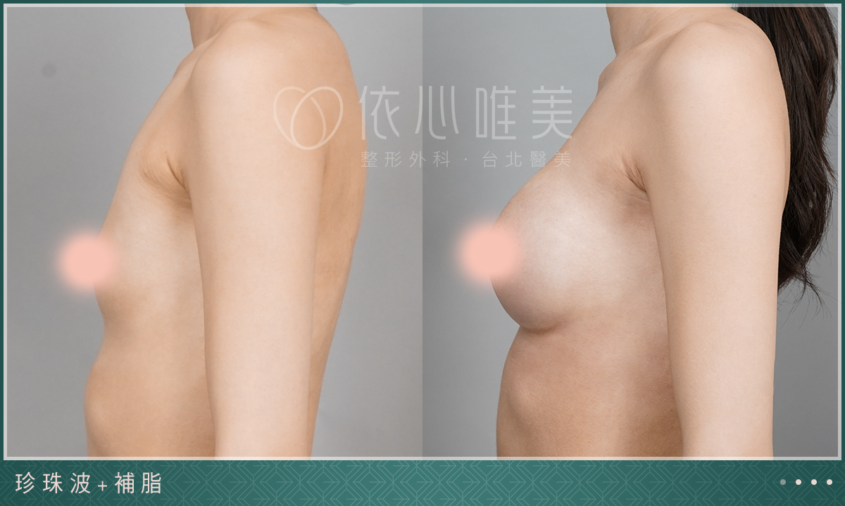 珍珠波＋自體補脂隆乳案例3